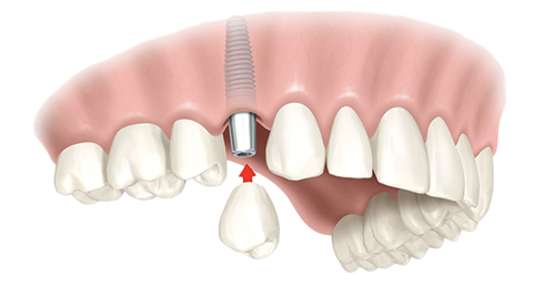Single Dental Implants South Hadley