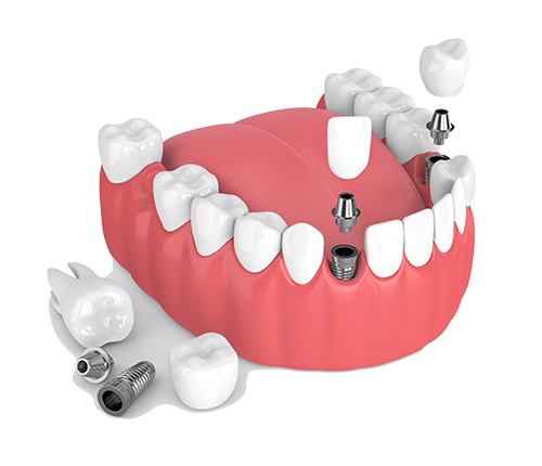 Multiple Teeth Dental Implants in South Hadley